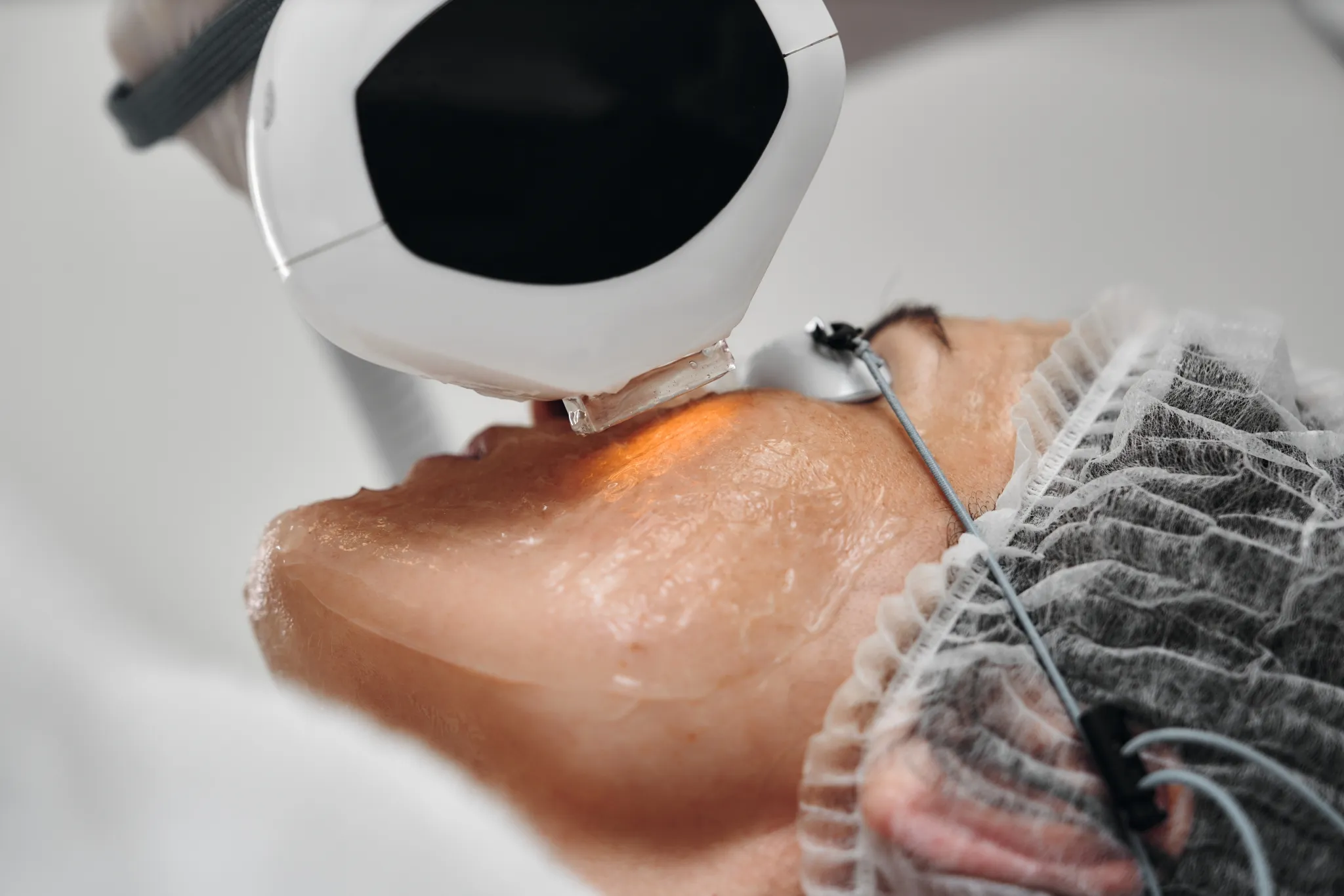 Soin laser de précision pour le visage en clinique esthétique
