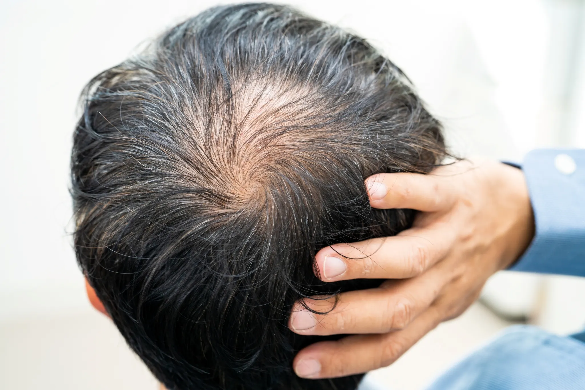 Perte de cheveux visible sur le dessus de la tête