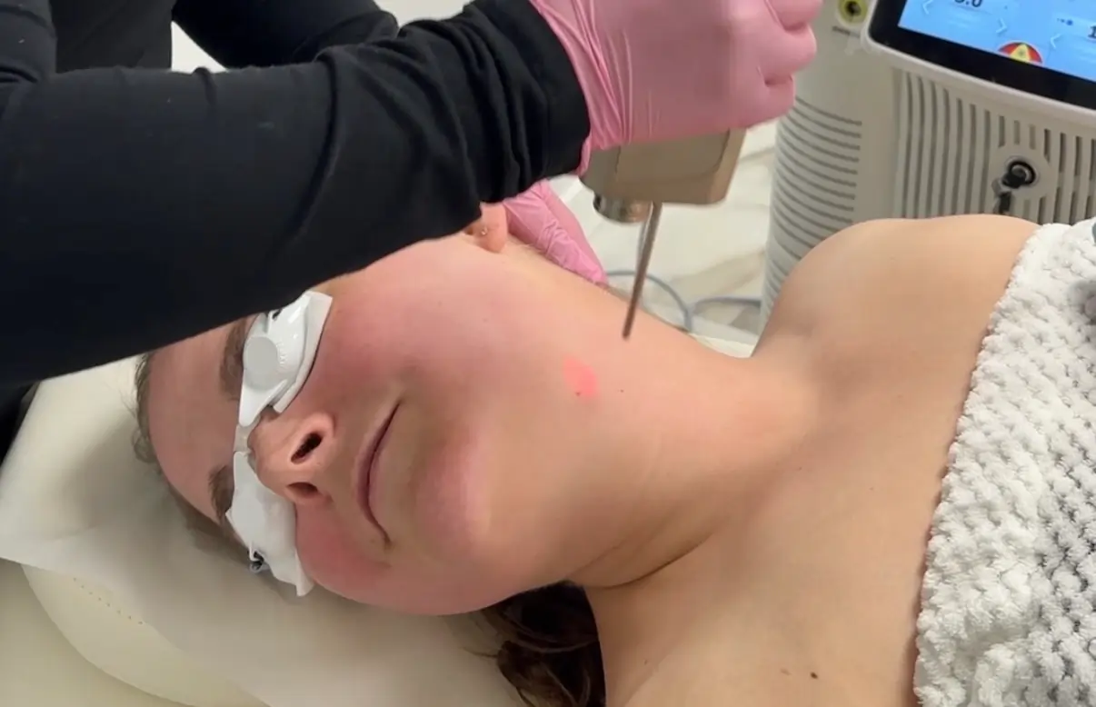 Traitement laser Fotona pour raffermir et rajeunir la peau du visage
